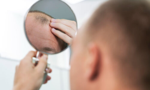 Soluzioni di Infoltimento Capelli Uomo: Combattere la Calvizie con Innovazione