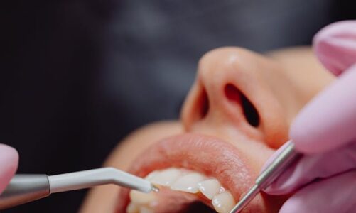 Impianto Dentale Rigettato: Cause, Sintomi e Come Prevenire il Fallimento