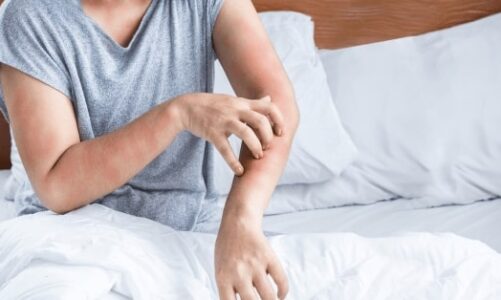Cimici da letto al rientro dalle vacanze: come prevenire e risolvere il problema con la disinfestazione